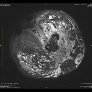 a. MRI thigh - axial, extensive abnormalities