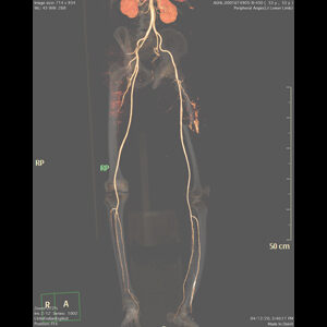c. CTA - Vascular abnormality at fracture