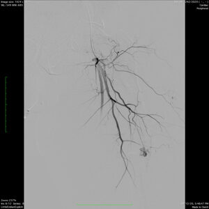 e. Angiography showing abormality at fracture site